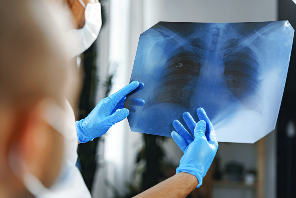 Male doctor examines an x-ray of lungs in hospital thumbnail