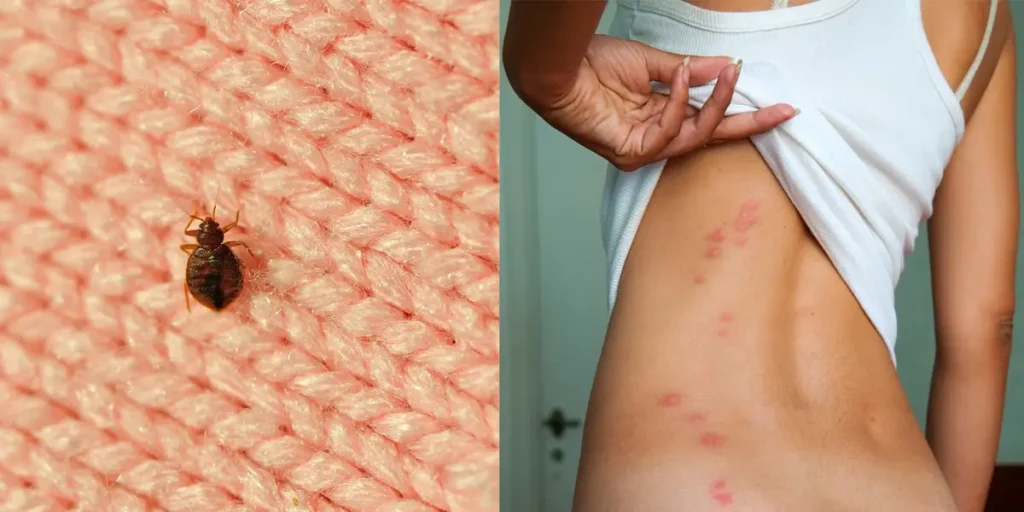 Insect Bites and Stings: What’s Normal vs. Dangerous thumbnail