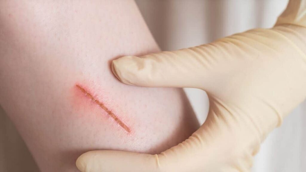 Minor Cuts and Lacerations: Do You Need Stitches? thumbnail