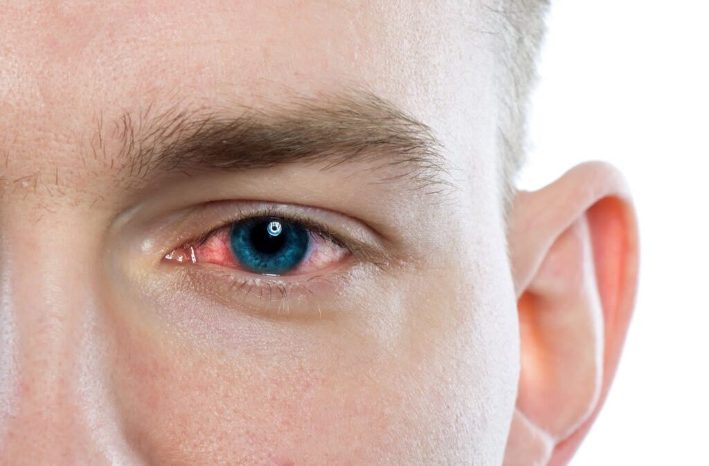 When Eye Redness Means Infection thumbnail