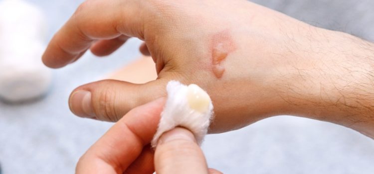 Burn Blister Care: What to Do and What to Avoid thumbnail