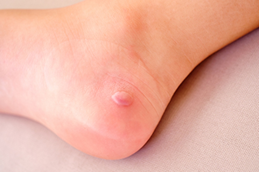 Should You Pop a Bite Blister? (And What to Do Instead) thumbnail