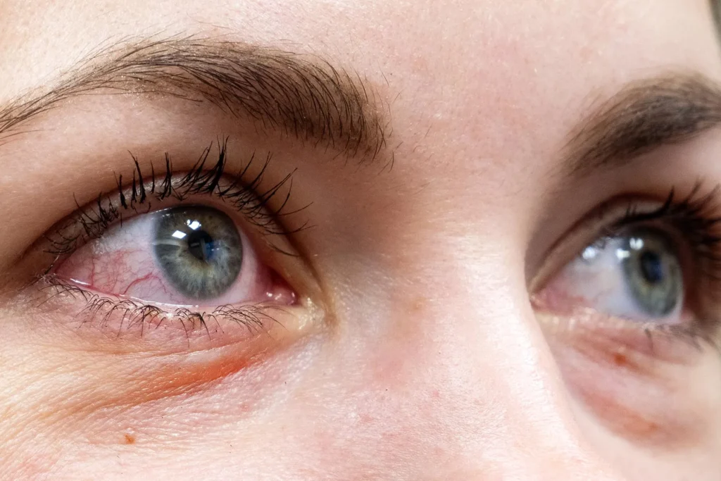 When Eye Redness Means Infection thumbnail