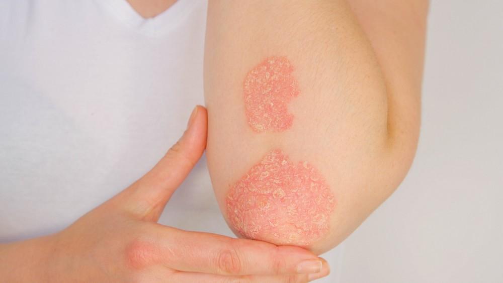 How to Treat a Mild Rash at Home thumbnail