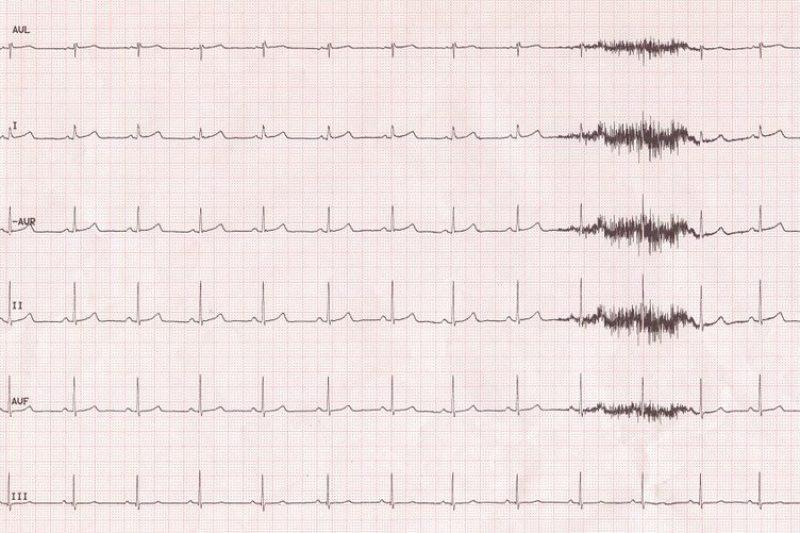 How EKGs Detect Heart Conditions thumbnail