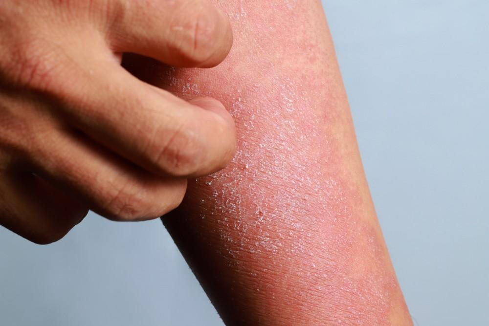 Home Remedies for Eczema Flare-Ups thumbnail