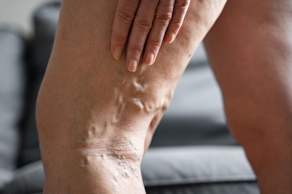What do your legs look like with heart failure? thumbnail