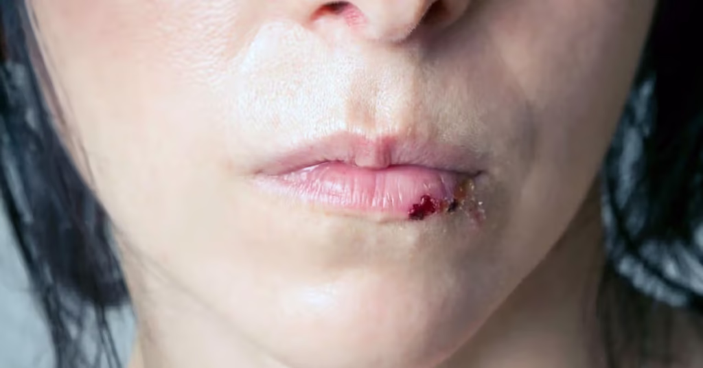 How to Treat a Bloody Lip at Home thumbnail