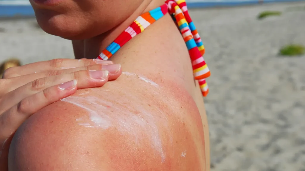 How to Soothe a Sunburn at Home thumbnail