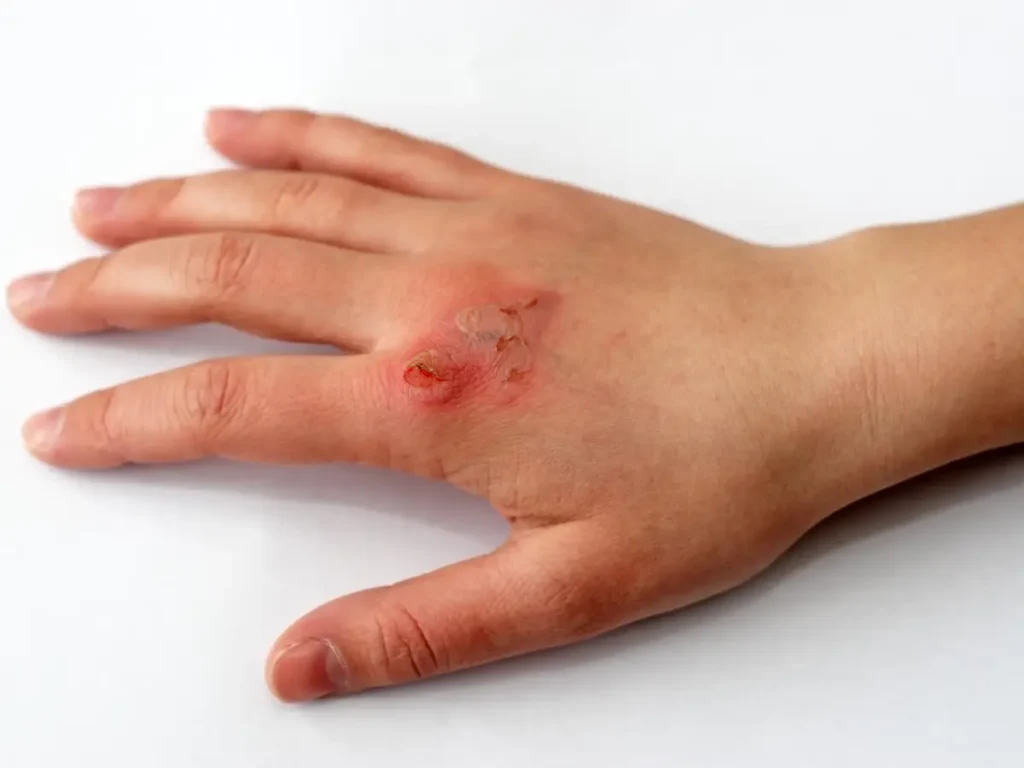 What to Do Immediately After a Minor Burn (First-Degree) thumbnail