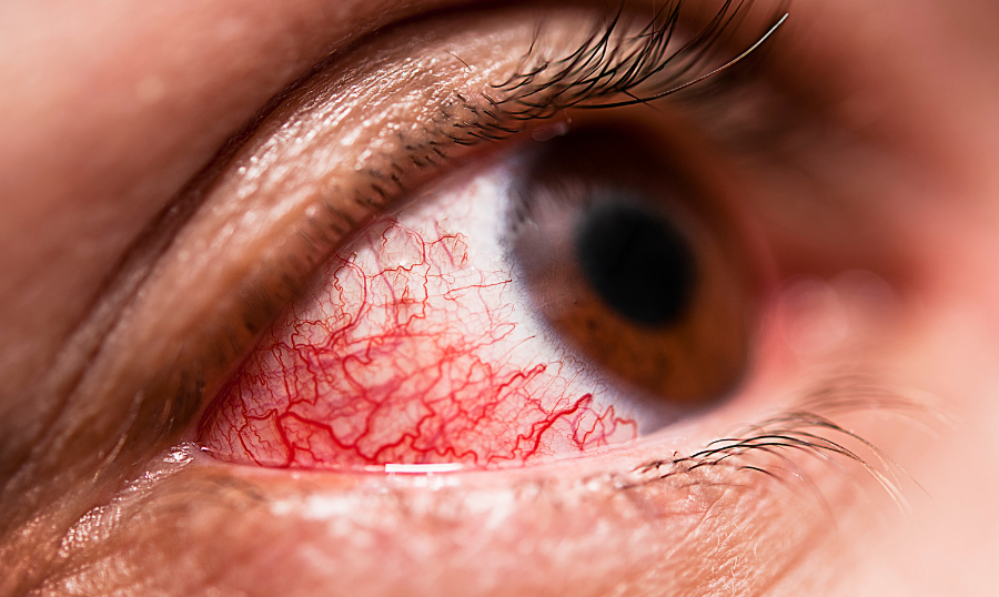 When Eye Redness Means Infection thumbnail