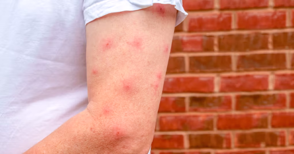 Should You Pop a Bite Blister? (And What to Do Instead) thumbnail
