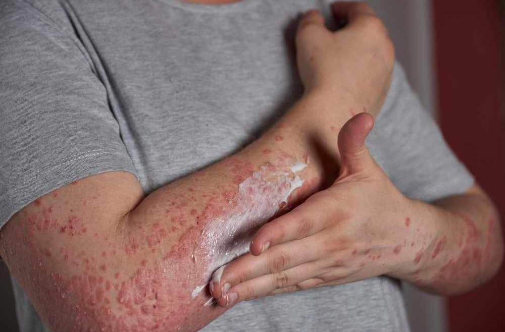 Best Over-the-Counter Options for Contact Dermatitis thumbnail