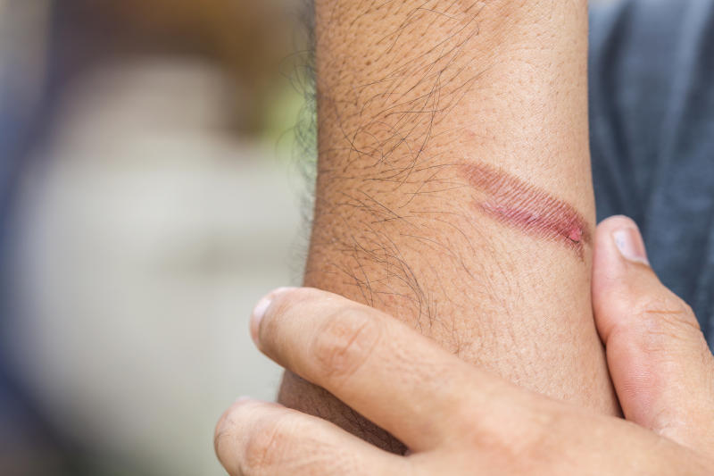 What to Do Immediately After a Minor Burn (First-Degree) thumbnail