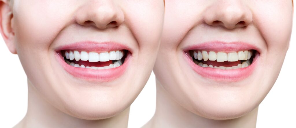 What to Do If You Chip a Tooth thumbnail