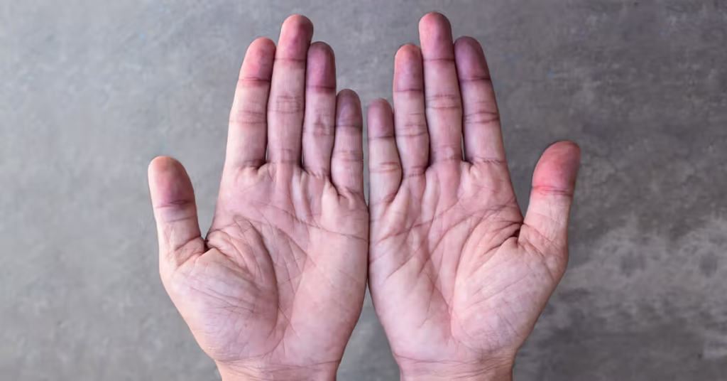 Which skin color indicates a loss of oxygen? thumbnail