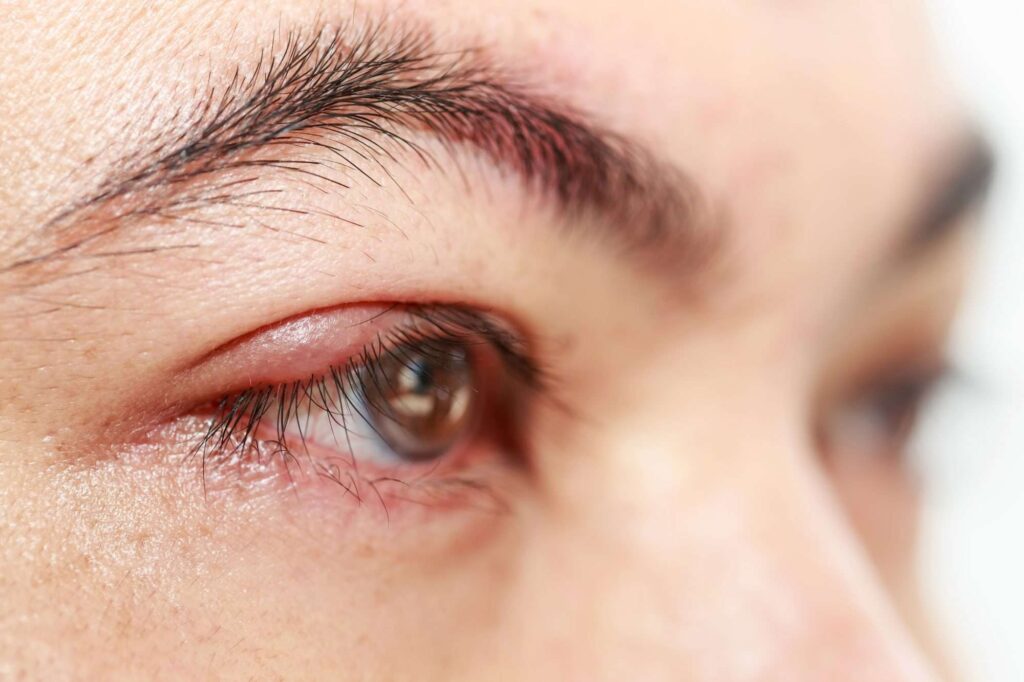Can urgent care treat a stye? thumbnail