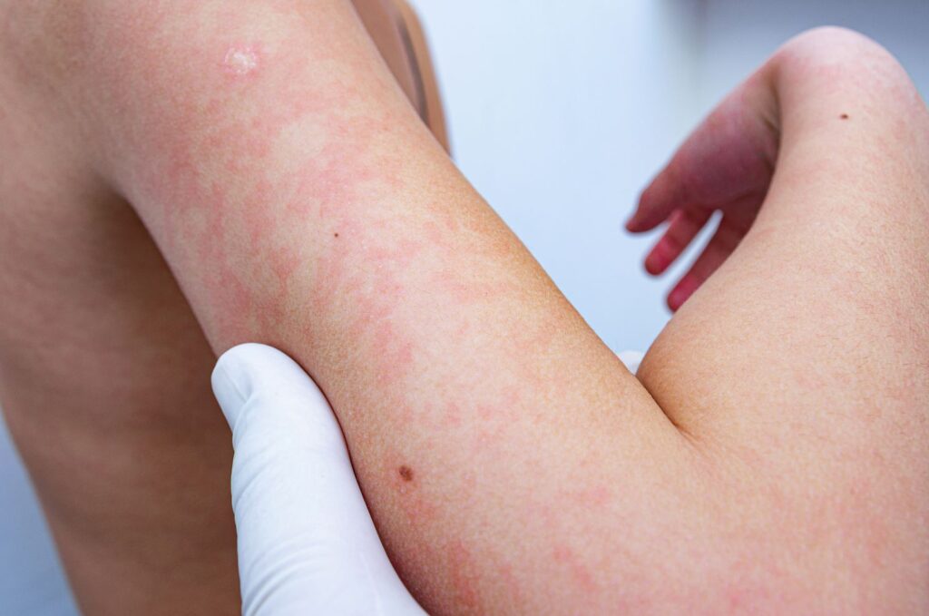 What to Do About a Heat Rash thumbnail