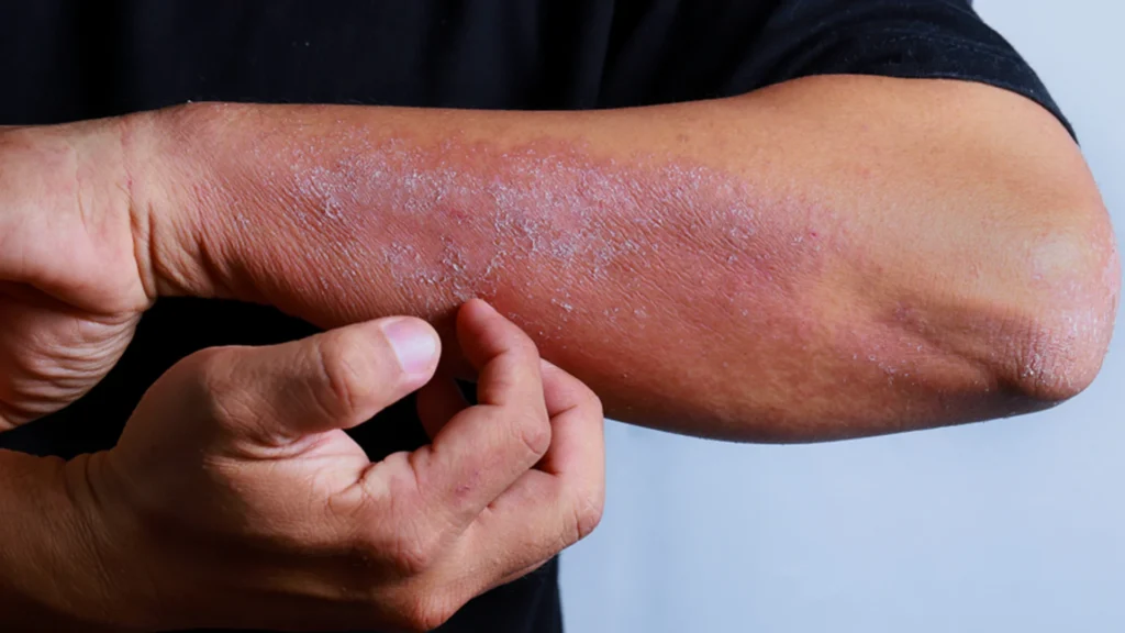 How to Stop a Mild Allergic Skin Reaction thumbnail