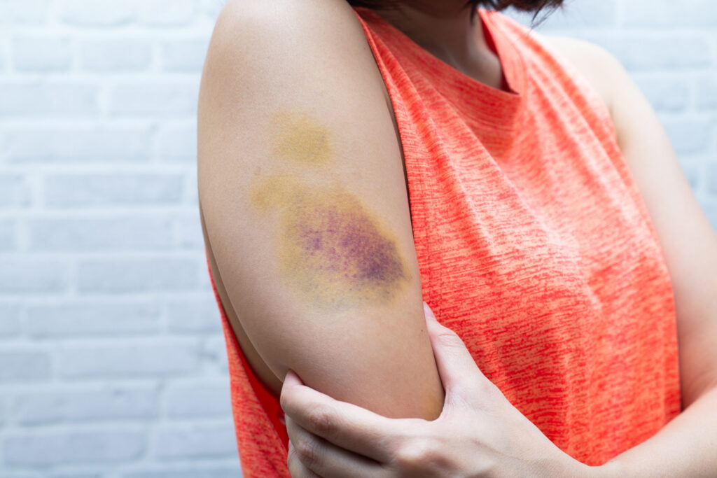 What That Purple Bruise Means (and How to Speed Healing) thumbnail