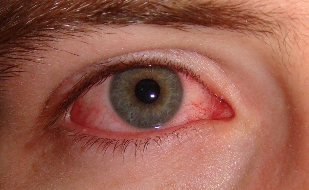 When Eye Redness Means Infection thumbnail