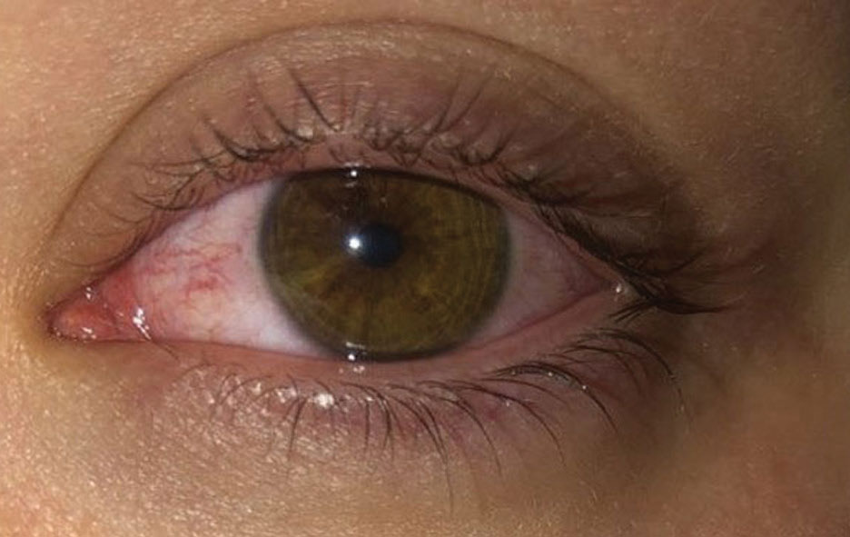 When Eye Redness Means Infection thumbnail