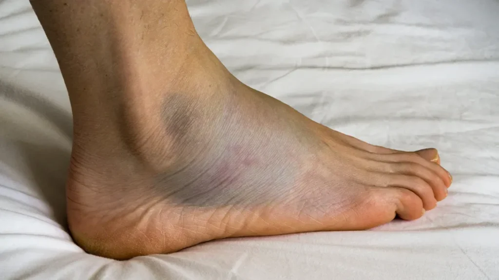 How to Reduce Swelling After a Twist or Fall thumbnail