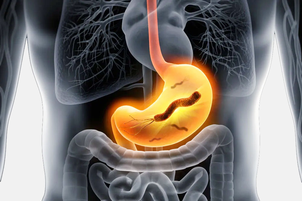 What are H. pylori symptoms? thumbnail
