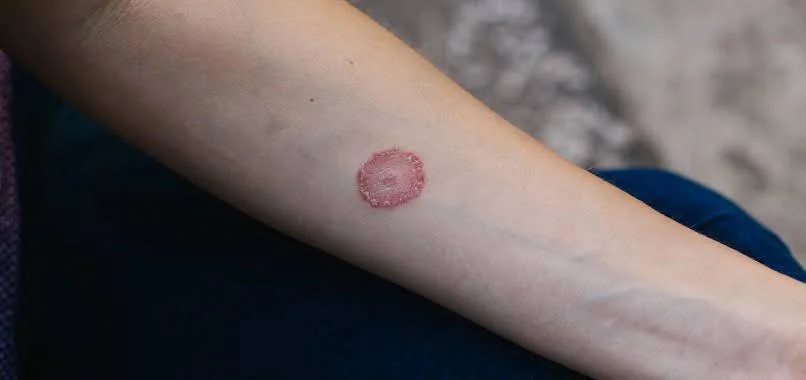 What is the bump after an IV? thumbnail