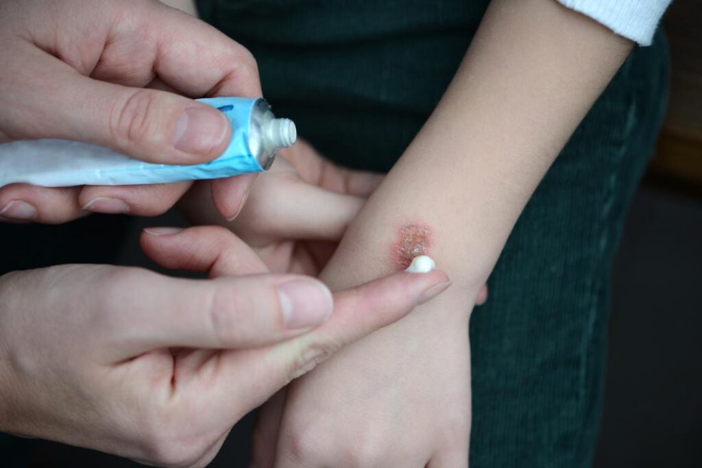 What Kind of Creams Are Best for Minor Burns? thumbnail