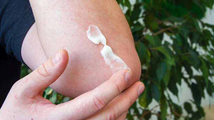 Natural Remedies for Itchy Bug Bites That Actually Work thumbnail