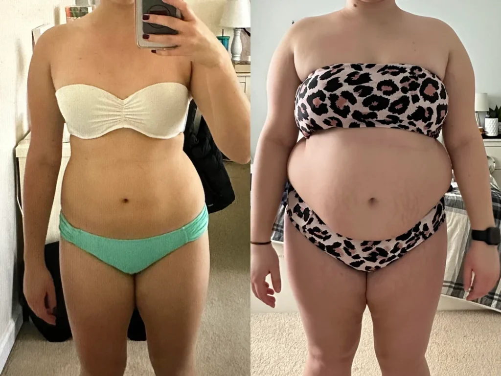 Do I have cushing’s or am I just fat? thumbnail