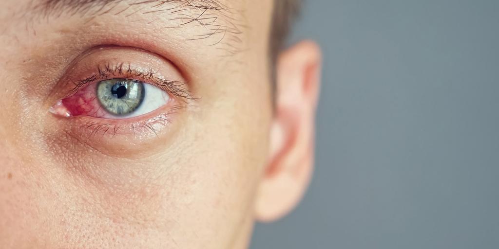 When Eye Redness Means Infection thumbnail