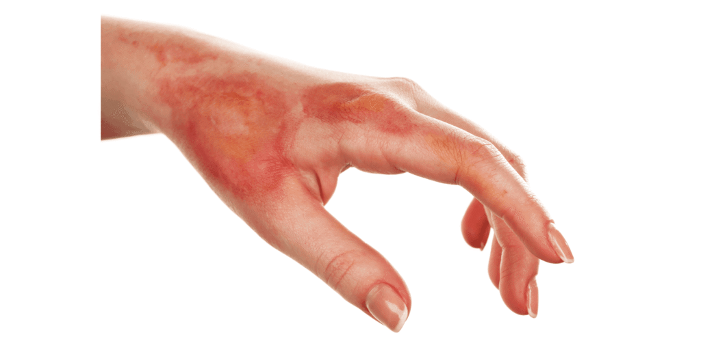 What to Do Immediately After a Minor Burn (First-Degree) thumbnail