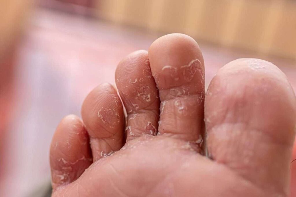 Managing Athlete’s Foot Without a Prescription thumbnail