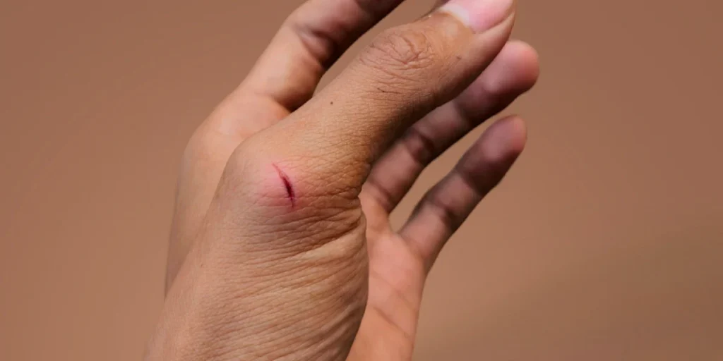 How to Treat a Minor Cut at Home (and When to Get Stitches) thumbnail
