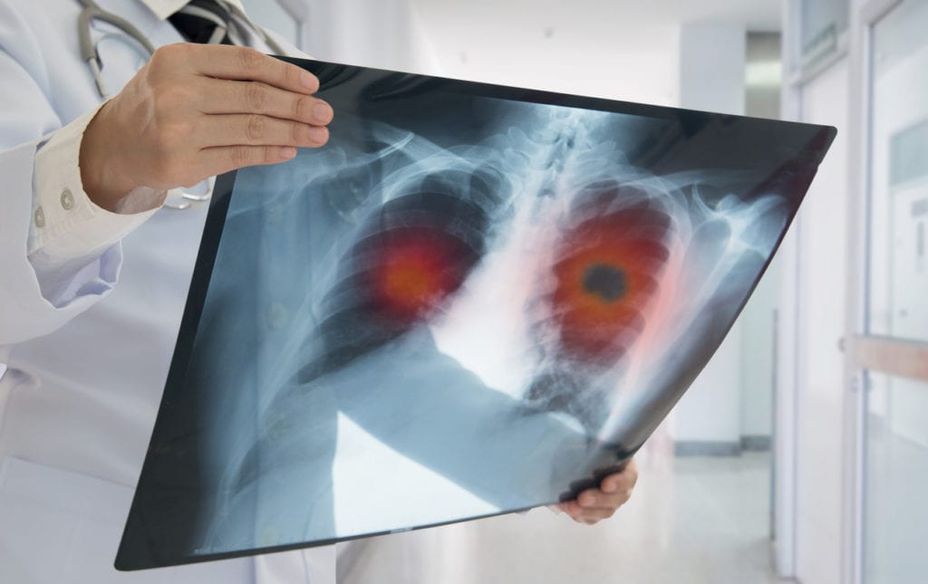 Screenings for Chronic Lung Conditions thumbnail