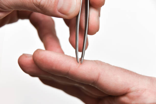 How to Handle a Splinter in a Wiggly Toddler thumbnail