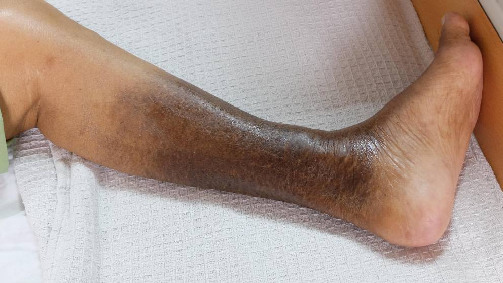 What color is skin with poor circulation? thumbnail