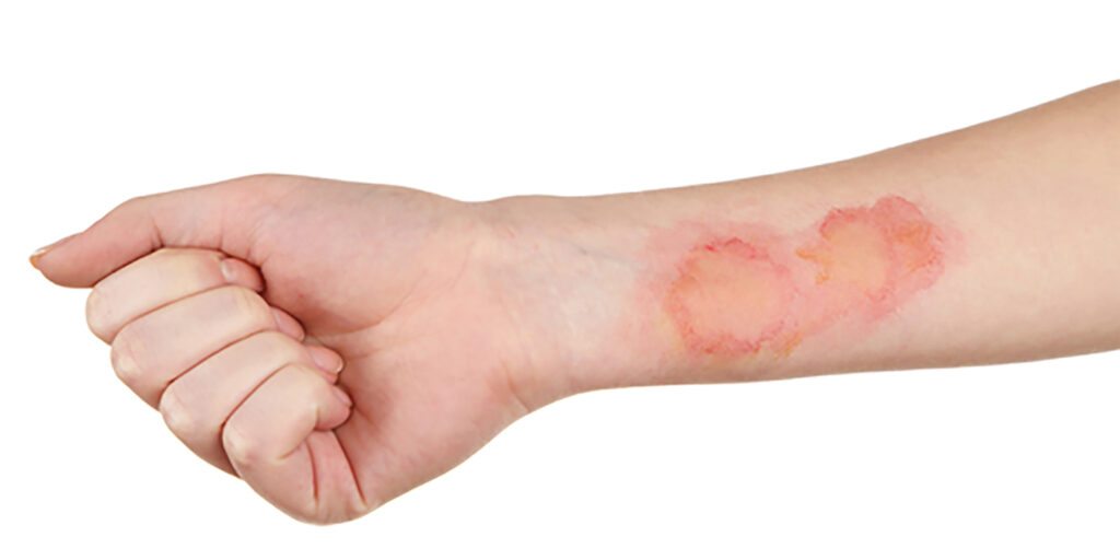 How Long It Takes Minor Burns to Heal thumbnail
