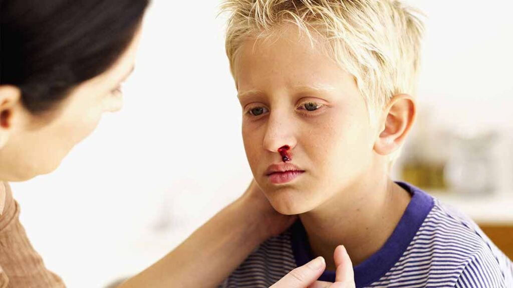 Managing a Nosebleed in Children thumbnail
