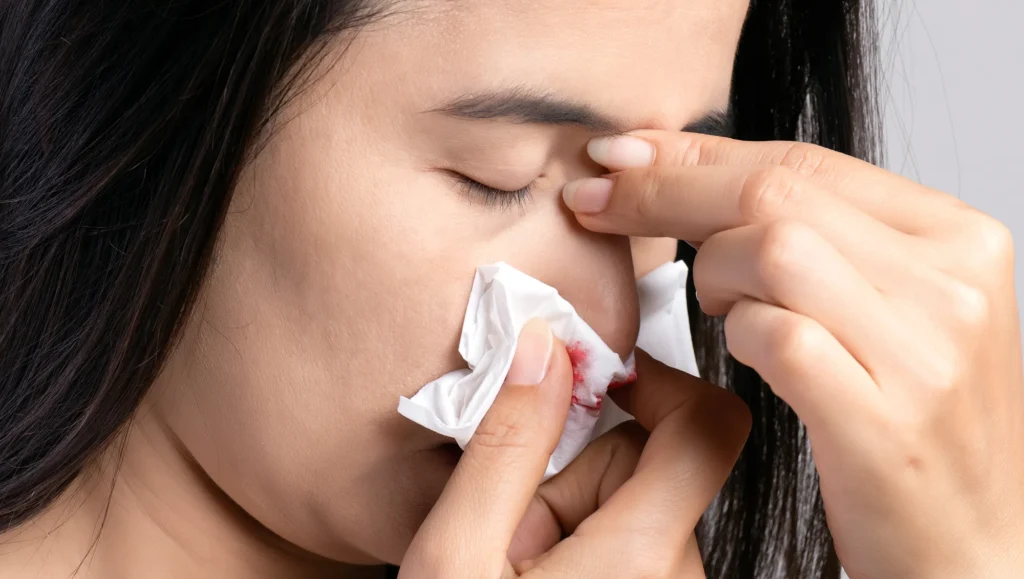 How to Stop a Nosebleed Quickly — Without Stuffing Tissues Up There thumbnail