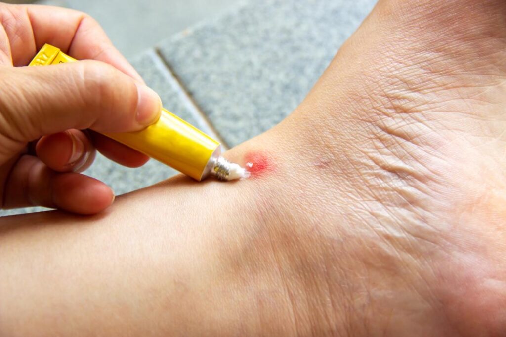 Best Creams and Gels for Bug Bites thumbnail