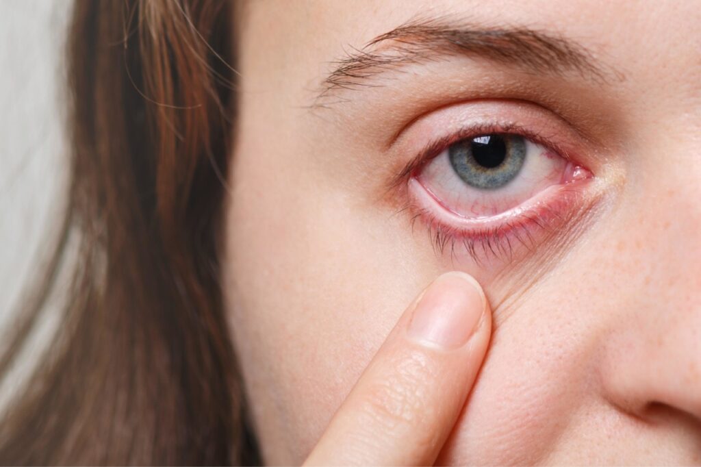 When Eye Redness Means Infection thumbnail
