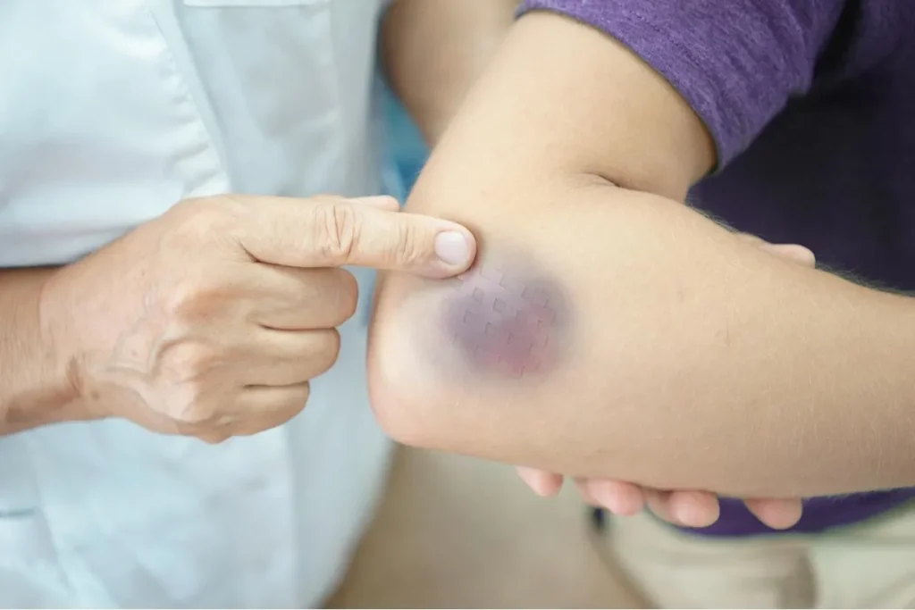 What That Purple Bruise Means (and How to Speed Healing) thumbnail