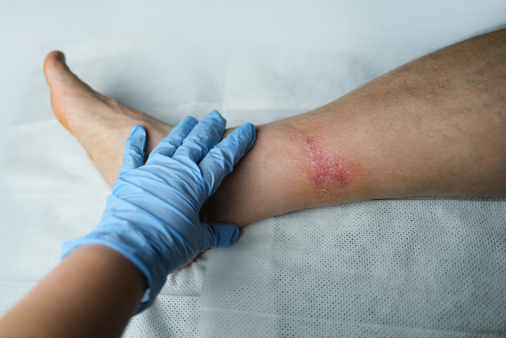 How to Know If a Wound Is Healing Properly thumbnail