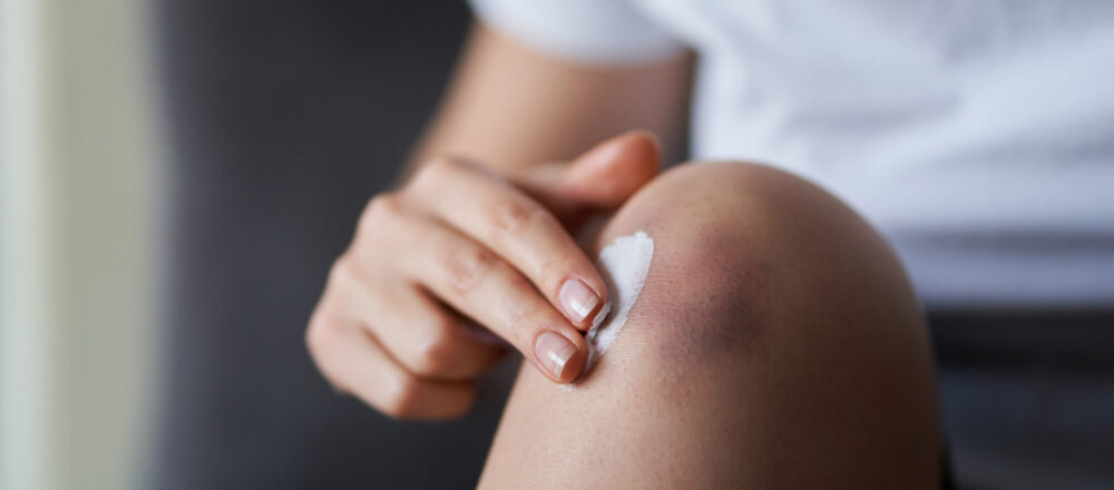 What That Purple Bruise Means (and How to Speed Healing) thumbnail