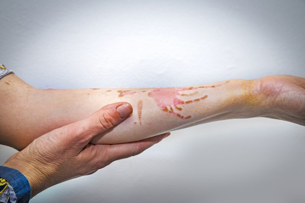 When a Burn Is More Serious Than It Looks thumbnail