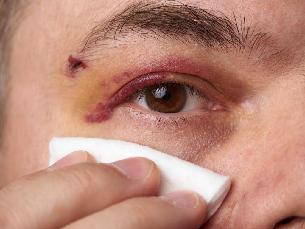 How to Handle a Black Eye at Home thumbnail